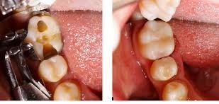 Οδοντιατρείο Οδοντίατρος Θεσσαλονίκη - Εμφράξεις σύνθετης ρητίνης