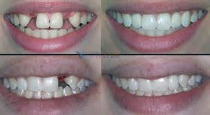 Spira Ολιστική Οδοντιατρική - Οδοντιατρείο Οδοντίατρος Θεσσαλονίκη - Γέφυρες
