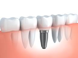 Spira Ολιστική Οδοντιατρική - Οδοντιατρείο Οδοντίατρος Θεσσαλονίκη - Εμφυτεύματα