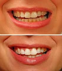 Spira Ολιστική Οδοντιατρική - Οδοντιατρείο Οδοντίατρος Θεσσαλονίκη - Λεύκανση δοντιών