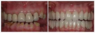 Spira Ολιστική Οδοντιατρική - Οδοντιατρείο Οδοντίατρος Θεσσαλονίκη - Ολική αποκατάσταση