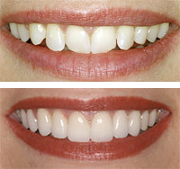 Ολιστική Οδοντιατρική - Οδοντιατρείο Οδοντίατρος Θεσσαλονίκη - Teeth Bonding